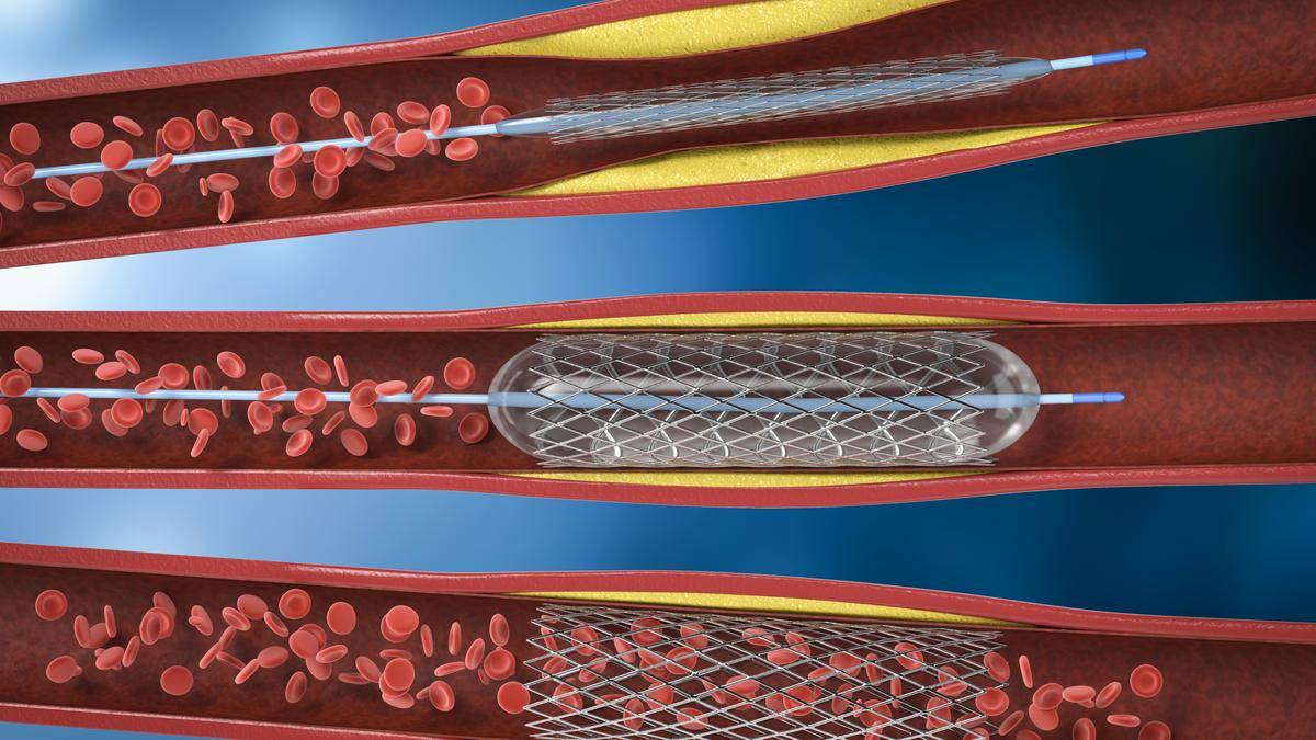 Are coronary stents necessary?